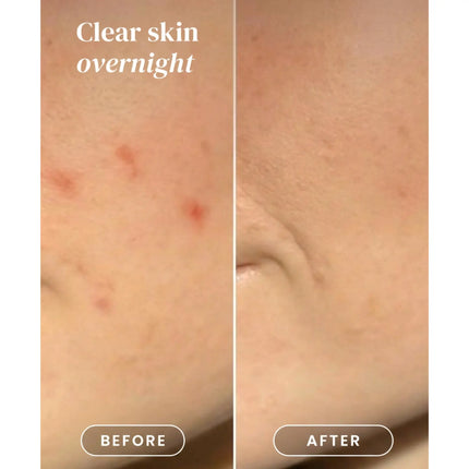 Apricot Beauty Pimple Patches
